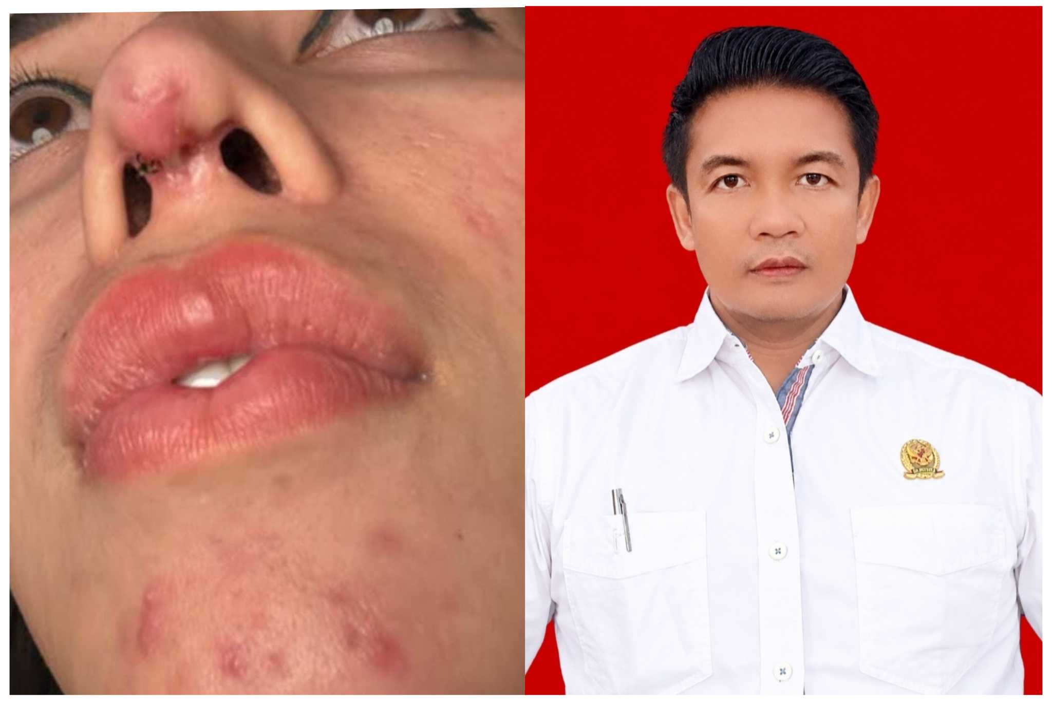 Dr. Didi Sungkono: Jika Unsur Malapraktik Terbukti, Tindakan Medis Dapat Berujung Pidana